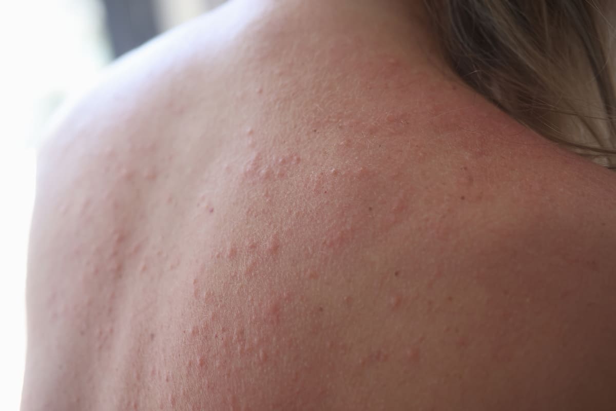 Diagnostico control y seguimiento de urticaria alérgica en niños y adultos en CDMX