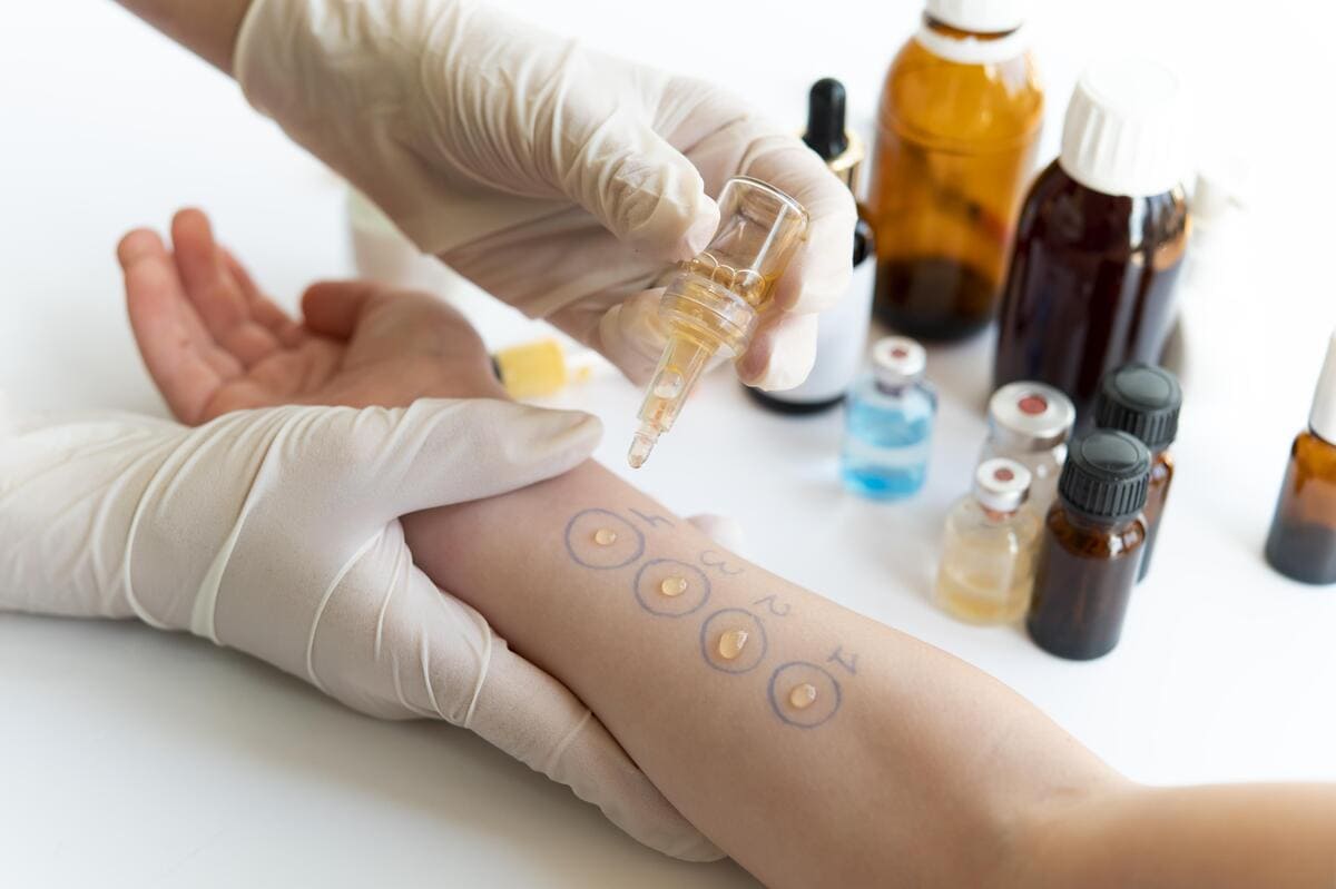 Pruebas cutáneas en CDMX: Diagnóstico preciso en alergia e inmunología clínica